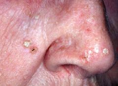 • Scaly/hyperkeratotic lesions on
sun exposed skin.
• Considered pre-cancerous, but
only about 1% evolve to SCC
• Atypical keratinocytes in lower
epidermis
• Underlying solar elastosis
(bluish dermis)
• Overlying parakeratosis
(...