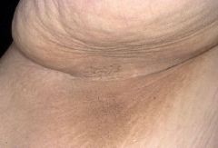 • Most common in obesity but rarely
associated with internal tumors.
• Clinically velvety brown plaques –
usually in the axillae