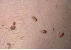 • AKA Acrochordons.
• Commonly known as skin tags.
• More common in obesity involving
neck, axillae, and groin areas.
• Can be associated with Acanthosis
Nigricans.