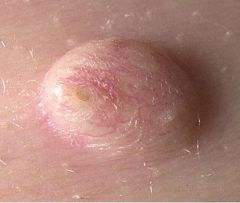• Sometimes referred to as “sebaceous
cysts”, but they aren’t.
• Expansion of hair follicle forms epithelial
lining. Also form as EIC’s from trauma.
• Pilar cyst has trichilemmal keratinization.
• Acne cyst results from follic...