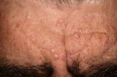 • Very common in middle aged and
elderly men.
• Umbilicated pale yellowish papules.
• Benign tumor of sebaceous glands.