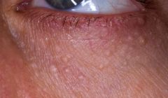 • Seen under the eyes of women.
• Small skin colored papules.
• Benign tumor of eccrine sweat glands.