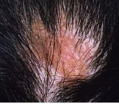 • Birthmark lacking hair when on scalp.
• Prepubertal may appear smooth yellow/orange.
• Adolescent has cobblestone surface.
• Adult form is prone to basal cell carcinoma.
