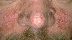 • Central facial papules.
• One manifestation of Tuberous
Sclerosis.
• Angiofibromas, histologically.