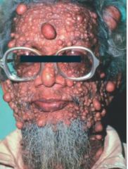 • Neurofibromatosis / Von Recklinghausen’s.
• Solitary lesion more commonly.
• Spindle cell tumor of Schwann cells and fibroblasts.