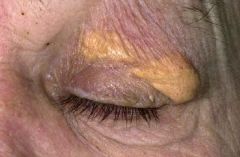 • Yellowish plaques on eyelids.
• Not strongly associated with increased
lipids – other xanthomas associated with
increased lipids.
• Foamy histiocytes contain the lipid.