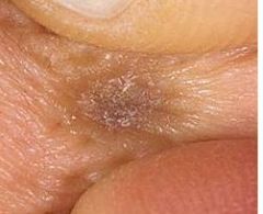 • Common on the legs of women.
• Brownish papule with “dimple sign”.
• Benign fibrohistiocytic tumor.