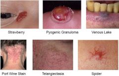 • Cherry angiomas most common
• Strawberry angiomas in children often
resolve spontaneously
• Pyogenic granuloma is a traumatic variant.
• Port wine stains are very common in the
form of a “stork bite” on posterior neck.
• Veno...