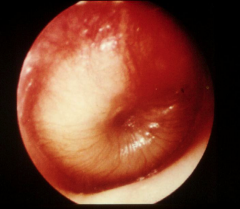Otitis media with middle ear effusion 