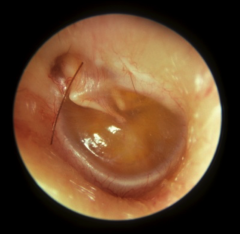 Middle ear effusion without signs of inflammation