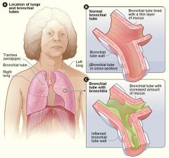 Acute inflammation of the tracheobronchial tree causing inflammation leading to bronchial edema and mucus formation. It is characterized by a cough, with or without sputum production. Other symptoms include sore throat, runny nose, nasal congestio...