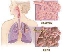 Noxious particles or gas (tobacco smoking)

Abnormal inflammatory response in lung