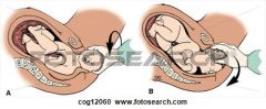 Maneuver for the management of shoulder dystocia


Placing the fetal head back into the pelvis and proceeding with a c-section. This is usually performed as a last resort