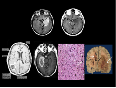 What type of glioma? Common on infiltration, fast or slow growing, mass effect, and imaging.