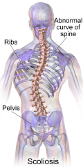 - lateral curvature of spine


 


- causes can be bony or muscular


   - muscle could be weak or tight


   - bony could be its shape