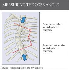 cobb angle measures how much the curve is of the spine