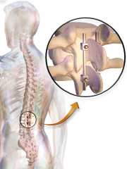 Surgically, attach Harrington Rods along side spinous process which keeps spine from rotating