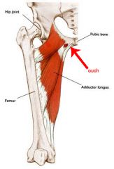 The bony attachment of the medial thigh muscles at the pubis can often become inflamed and cause pain