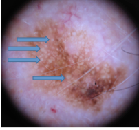Using dermoscopy, how can you tell if a lesion is seborrheic keratosis? Will you see? Describe.