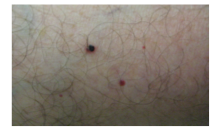 Occasionally, cherry angiomas may bleed or thrombose. What do they resemble?