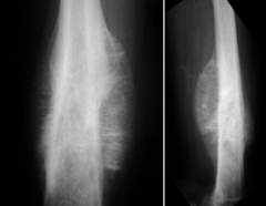 A 24-year-old man "twists" his knee in a softball accident. He denies any preceding complaints and is very active and healthy. Figures A and B include radiographs and histology of the lesion. These findings are most consistent with what diagnosis?...