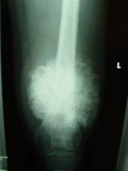 A 47-year-old man presents with increasing left knee pain and swelling. There is no history of trauma and he is otherwise healthy. Representative radiograph, MRI, and histology are shown in Figures A through D. What is the most likely diagnosis? 
...