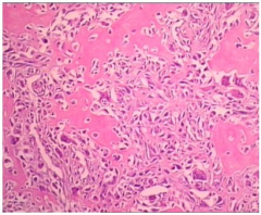 Periosteal osteosarcoma is an extremely rare intermediate grade surface osteosarcoma that usually occurs in patients 15 to 25 years of age. Treatment is the same as intramedullary osteosarcoma and consists of neoadjuvant chemotherapy, surgical exc...