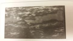  


 


How would you describe this plaque?


 


- Fatty streak


- fibrous plaque


- heterogeneous plaque


 


 