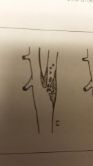 Match the atherosclerotic change w/the image 


 


A) stenosis


B) stenosis w/surface platelets


C) Embolic process


D) Thrombosis