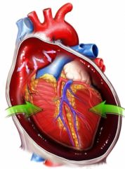 investigations:
- ekg
- echo
- cardiac catheterization

management:
- pericardiocentesis (echo guided)
- pericardiotomy
- avoid diuretics and vasodilators (these decrease venous return to already under filled rv --> dec lv preload --> dec....