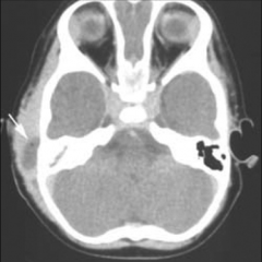 CT - opacified mastoid aircells, middle ear opacification, soft tissue swelling


Treatment - IV antibiotics, Tubes (+/-) to drain fluid and collect fluid to be sent to lab 