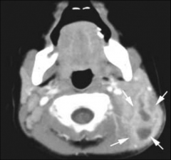 Spread of infection through mastoid tip to upper neck 


Presents with AOM and upper neck mass 


Treatment - IV antibiotics, mastoidectomy, drainage of abscess 