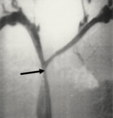 Restriction of the superior vena cava which restricts blood return to the heart which can cause dyspnea, swollen face, and coughing. Mostly caused from lung cancer.