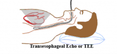 A transesophageal Echocardiogram where a transducer is lowered through the esophagus to ultrasound the heart. This is possible through the location of the esophagus posterior to the left atrium
