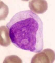 Cell involved in what leukemia?