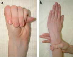 A positive thumb sign (steinberg sign)
