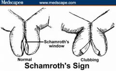 Positive shamroth sign abolishes the diamond-shaped window seen in normal fingers. 

Dx: clubbing