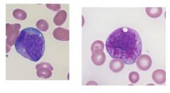 Leukemia type with these cells?