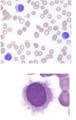 Leukemia associated with this cell type?