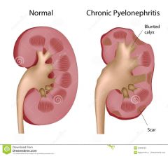 -Persistent or recurrent infection of the kidneys, leading to scarring of the kidneys-Inflammation and fibrosis, located in the interstitial spaces between the tubules, leading to chronic kidney failure

Treatment
-Antibiotic administrationProlong...