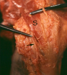 The saphenous nerve is most at risk during the hamstring harvest of an ACL reconstruction. At the joint line, the saphenous nerve is deep to the broad sartorious fascia, and superficial to the gracilis. Bertram et al describe a case report of a pa...