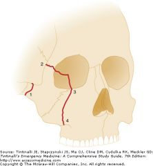Orbital wall blowout fracture (EOM entrapment?)


 


Tripod fracture [FIZL =FrontoZyg suture, IO rim, Zygomatic Arch, Lat Maxillary wall)




Le Fort fracture