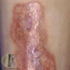 Yellow or red patch with marked telangiectasia that looks like ‘lipid’. It is most
common on the shins. It may be raised, but also may be atrophic and even ulcerate.
20% of patients are diabetic 


Pathology shows necrobiosis

Mx: topic...