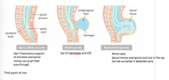 spina bifida: 
most common neural tube defect 
the neural tube forms but the supporting tissue does not 