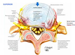 usually herniates posteriorly 
- spinal nerves very close by 