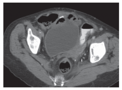 Next step for bowel obstruction from recurrent ovarian cancer

A. NG T
B. percutaneous endoscopic gastrostomy tube
C. endoscopic colorectal stent
D. ileostomy
E. cecostomy tube 