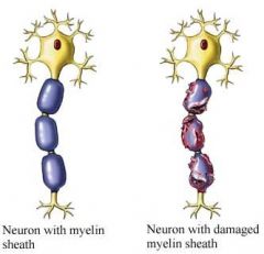 MS is a desease which damages the myelin sheath of neurons.  What problem would this cause with signal propagation?  

A: signal conducted too fast 
B: impulse triggered too often 
C: neuron threshold lower 
D: lower resistance to leakage