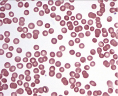A 26 year old white man presents to the physician with anemia. His grandfather, father, and sister have similar symptoms, which have been attributed to an inherited genetic mutation. Ther peripheral blood smear is show in the image.
 
which of the...