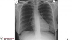 Does this patient have a normal cardiothoracic ratio?