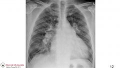 Does this patient have a heart problem or lung problem? How can you tell?